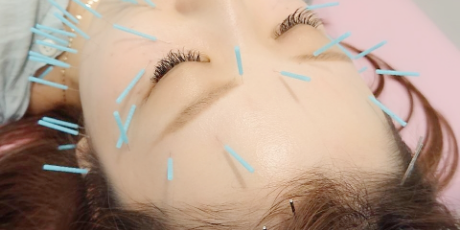 美容鍼